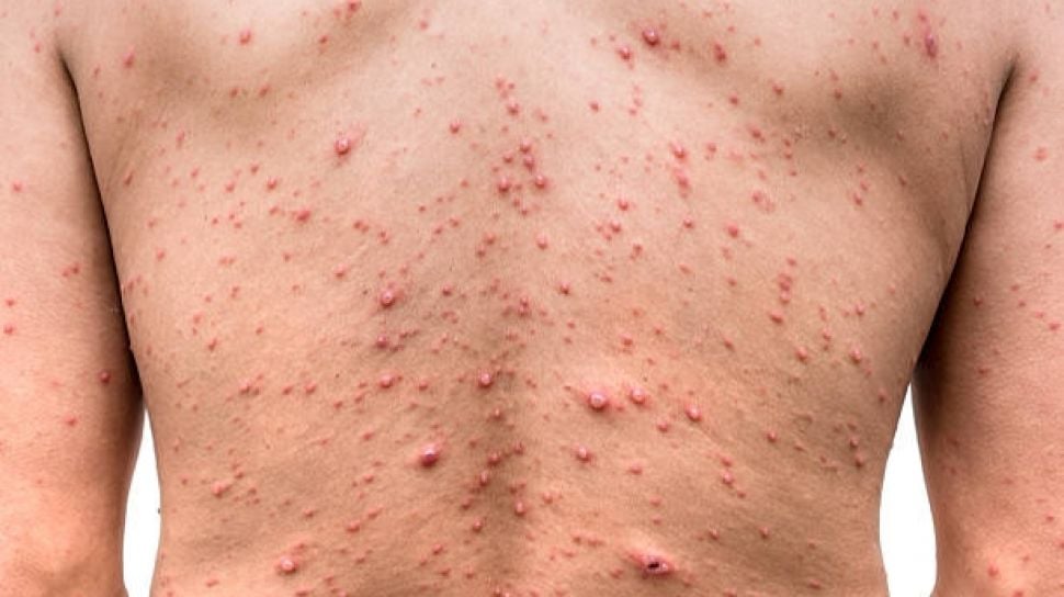 Hadapi Wabah Mpox, Menkes Pastikan Obat dan Vaksin Tersedia Cukup